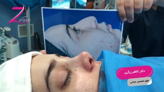 نتیجه بی نظیر عمل بینی در اتاق عمل