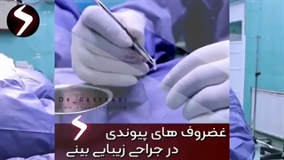 غضروف های پیوندی در جراحی زیبایی بینی مصنوعی هستند