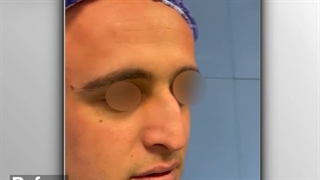 بلافاصله بعد از جراحی زیبایی بینی و انحراف بینی | دکتر خوروش