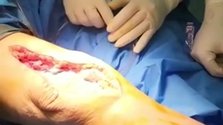 رویژن تعویض مفصل زانو نوع پرایمری به cck