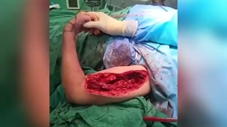 عمل رویژن شکستگی بازو