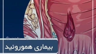 هموروئید