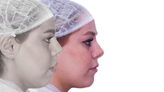 درمان اپن بایت با ارتودنسی | دکتر داودیان