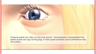 جراحی پلک یا بلفاروپلاستی _ هزینه و توصیه ها