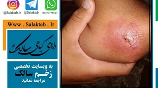 خطر گزش سالک مرطوب روستائی مناطق آلوده