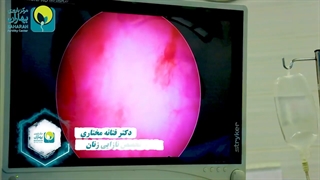 خراش اندومتر برای انتقال جنین