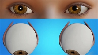 اصلاح انحراف چشم یا استرابیسم