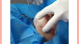 لیفت یا درمان غبغب با روش های بدون جراحی