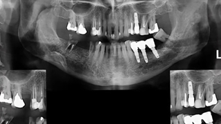 ایمپلنت فوری همزمان با کشیدن دندانها همراه با پیوند استخوان