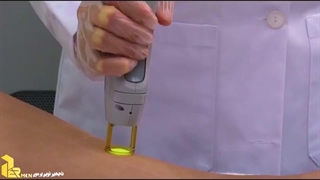 مقایسه دو دستگاه لیزر کندلا و سوپرانو