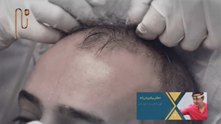 درمان ریزش مو به روش ترکیبی سه گانه
