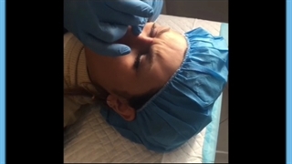 آشنایی با انواع روش های لیفت بینی بدون جراحی/ ژل و نخ