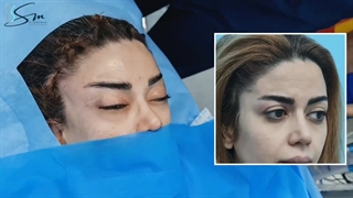 فیلم جراحی لیفت اندوسکوپی ابرو و شقیقه