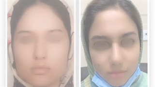 فیلم جراحی زیبایی بینی