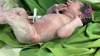 فیلم واقعی زایمان سزارین و تولد نوزاد