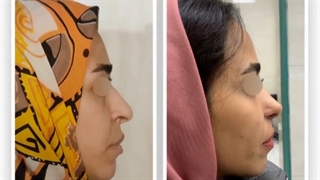 فیلم واقعی عمل بینی طبیعی دکتر سرشار زاده