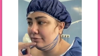 لیفت یا درمان غبغب با روش های بدون جراحی