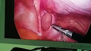 جراحی فتق کشاله ران