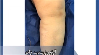 جراحی آرتروز شدید زانو