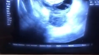 بارداری موفق بعد از 10 سال (با روش IVF)