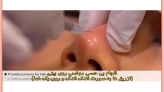 آشنایی با انواع روش های لیفت بینی بدون جراحی/ ژل و نخ