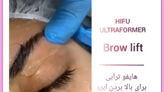 هزینه بهترین روش لیفت ابرو بدون جراحی اینسایزینگ