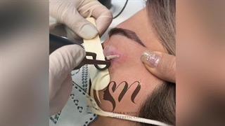 پاک کردن تتو خط چشم ( کلینیک زیبایی استار بیوتی )