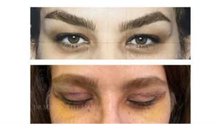 عمل جراحی رینوپلاستی و بلفاروپلاستی