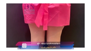 از بین بردن سلولیت ران با دستگاه اوندا