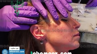 آموزش 0 تا 100 لیفت با نخ کاگ