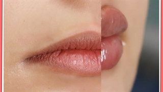 آنچه در مورد تزریق ژل نمی دانید