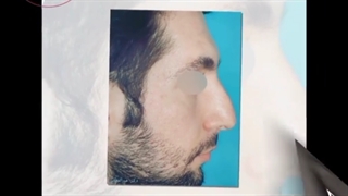 یکماه بعد از عمل بینی گوشتی/غضروفی