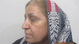 عمل لیفت کل صورت