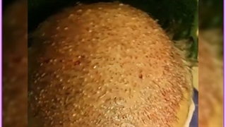 مراحل، مزایا و هزینه کاشت مو به روش SUPER FUE