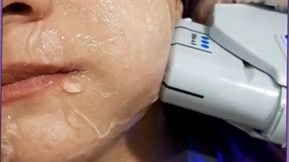 مراقبت های بعد از هایفوتراپی