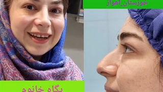 جراحی بینی گوشتی و کج در اهواز | دکتر محمدعلی حسینی پاکسازی پوست