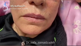 لیفت صورت با نخ سیلوئت