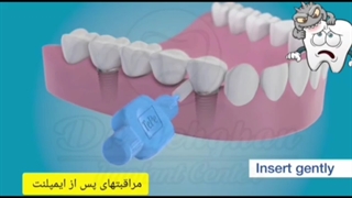 دکتر وحید دهقان: مراقبتهای پس از ایمپلنت