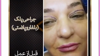 هزینه جراحی پلک چقدر است؟ ترمیم زیبایی دندان