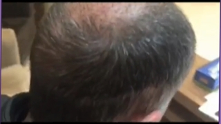 هزینه، مزایا و مراحل کاشت مو به روش میکروگرافت