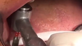 ایمپلنت دندان