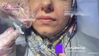 تزریق ژل به خط لبخند
