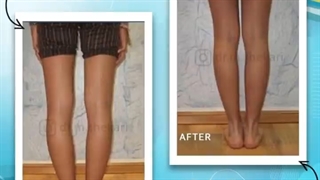 درمان پای پرانتزی بدون جراحی