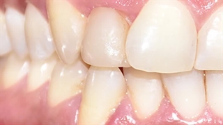 استریپ کردن دندان.متخصص ارتودنسی دکترعلیرضاخدیوی