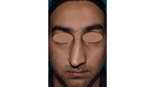 اصلاح انحراف بینی با رینوپلاستی | دکتر شاهرخ خوش سیرت