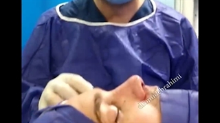 قبل و بعد از جراحی بینی گوشتی با قوز و افتادگی نوک بینی | دکتر امید ابراهیمی