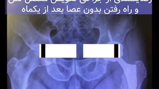 رضایت بیمار از جراحی تعویض مفصل لگن و راه رفتن بدون عصا بعداز یکماه