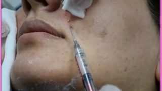 راهکار قطعی از بین بردن خط خنده با تزریق ژل برداشتن خال