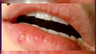 تبخال چیست و چگونه درمان می شود؟