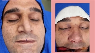 یک هفته بعد از جراحی بینی